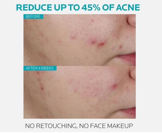 La Roche-Posay Effaclar Salicylic Acid Acne Treatment Serum – 30ml (1.0 fl. oz.) Daily Clarifying Exfoliator